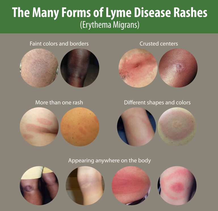 Examples of the different types of Lyme Disease rashes to help illustrate that not all display the traditional bull's eye pattern.